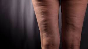 Hold a dumbbell in each hand, palms should be facing in. 15 Myths And Facts About Cellulite Abc News