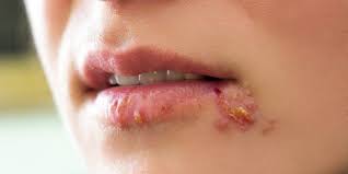 Normale hautcremes besitzen diese antivirale wirkung nicht und bekämpfen somit auch nicht die ausbreitung des virus. Lastiger Lippenherpes Herpes Ubertragt Sich Unbemerkt Und Bleibt Lebenslang Heilpraxis