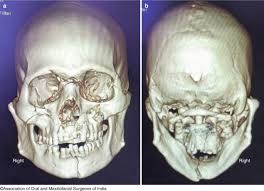 Image result for Jaw Dislocation