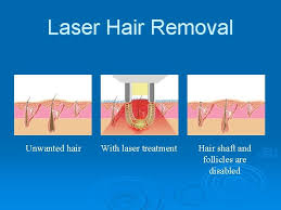 It's just that since each follicle must be treated, electrolysis is a slow. Laser Hair Removal Presentation Laser Hair Removal How
