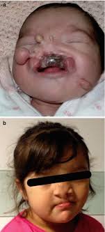 Nasal polyps are completely inflammatory in origin. Median Cleft Lip And Palate Cutaneous Nasal Polyps And Corpus Callosum Lipoma A Case Of Pai Syndrome Associated With Ventricular Septal Defects Radiology Key