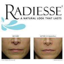 Check Out Our Monthly Special 100 Off Radiesse A Volumizing Filler For Wrinkle Reduction Receive A 50 Instant Wrinkle Reduction Cosmetic Surgery Wrinkles