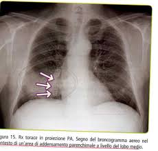 L'embolia polmonare è l'ostruzione delle diramazioni dell'arteria polmonare. Radiologia E Casi Clinici Aims Flashcards Chegg Com