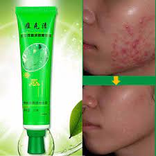 Krim ini berfungsi dengan keajaiban pada setiap jenis kulit dari kering hingga berminyak hingga sensitif, dan ia menyusut parut lama atau baru dari luka bakar, luka, pembedahan, dan banyak lagi. Krim Hilangkan Parut Jerawat Acne Cream Scar Removal Face Cream Shopee Malaysia