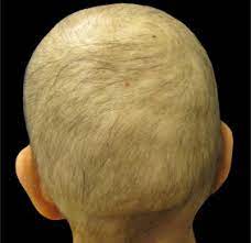 Most of the time, early diarrhea goes away and is not severe. Scalp Cooling To Prevent Chemotherapy Induced Alopecia Sciencedirect
