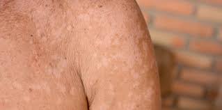 Biasanya panau terjadi di bahagian kulit di mana terdapat banyak penghasilan sebum (minyak) seperti bahagian dada, belakang badan, muka, kulit kepala, lengan dan leher. Petua Hilangkan Panau Yang Terbukti Efektif Jom Cuba Sekarang Juga