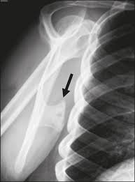 Image result for Snapping Scapula