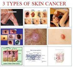 In the uk, in 2017 there were 16,173 cases (8,168 cases for men, 8,001 cases for women) of melanoma; Pin On Disease Or Cancer