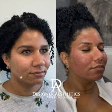 Lipo Shots & Fat Melting