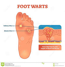 Our clip art resources can be commercial used daily update images over millions of images. Diagram Of Warts Fusebox And Wiring Diagram Series Bacon Series Bacon Parliamoneassieme It