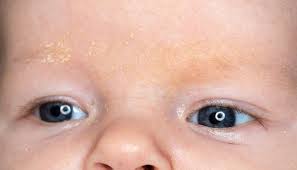 Image result for yellow scabs on the face in children