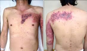 Image result for "Herpes Zoster"