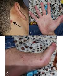 Image result for Hand foot and mouth disease HFMD roof of mouth
