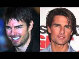 Here's what i've learned since my first cosmetic procedure 25 years ago. Tom Cruise Before And After Plastic Surgery Photos Youtube
