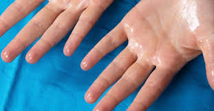 Image result for Hyperhidrosis