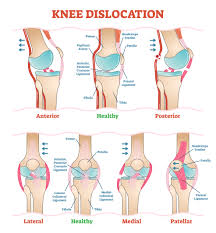 Image result for Knee Dislocation