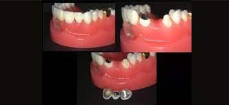 Maybe you would like to learn more about one of these? Mahkota Gigi Tiruan Dan Jembatan Gigi The Implant And Oral Surgery Centre