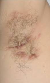 Hidradenitis Suppurativa Nadir Hastaliklar