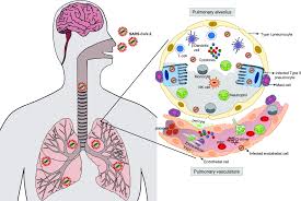 Anna ong is on facebook. A Canadian Perspective On Severe Acute Respiratory Syndrome Coronavirus 2 Infection And Treatment How Prevalent Underlying Inflammatory Disease Contributes To Pathogenesis