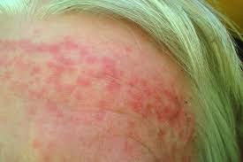 Although bedbugs do bite humans, they are not known to transmit diseases to people. Identifying Common Summer Bug Bites