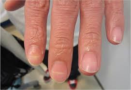 Image result for Beau lines feet