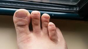 Image result for Beau lines feet
