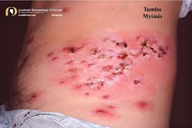 I know i have morgellons aka fly myasis this is working on my 3rd yr. Tumbu Myiasis Cordylobia Anthropophaga Academic Dermatology Of Nevada