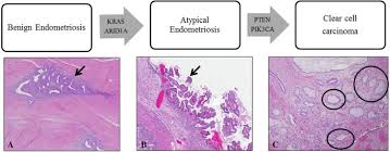 These are the eight conditions that endometriosis is often mistaken for. Understanding Malignant Transformation Of Endometriosis Imaging Features With Pathologic Correlation Springerlink