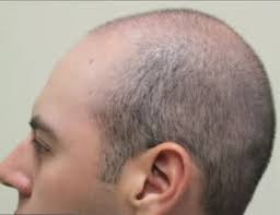 Inflammation is very often correlated with male pattern hair loss. Pgd2 Prostaglandin Pathways Factor Opens A New Hair Loss Treatment Posibility