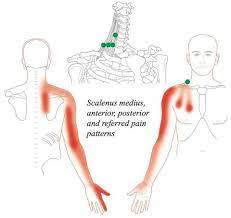 How To Truly Identify And Treat Thoracic Outlet Syndrome Tos Msk Neurology