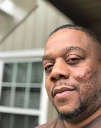 Sarcoidosis Awareness Day #10 Scars In 2016 I visited a dermatologist for  what I thought to be some sort of abscess. It turns out that after several  tests, I was diagnosed with