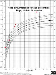 Head Circumference Chart Showing Macrocephaly Download