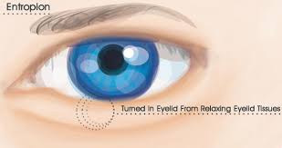 Image result for Entropion