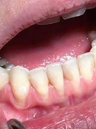 See full list on petmd.com Treat Gum Recession With Good Dental Care Loop Perio