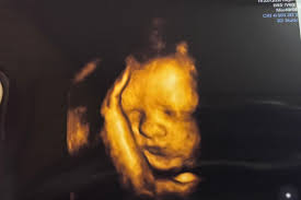 Miracles Happen 3D/4D/HD Ultrasound