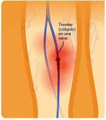 Trombosis Venosa Dr Cristian Anez Martinez