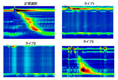食道アカラシア | KOMPAS – 慶應義塾大学病院 医療・健康情報サイト