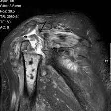 4.6 out of 5 stars. Milwaukee Shoulder Syndrome Eurorad