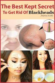 Natural Way To Remove Blackheads From Your Nose Get Rid Of Blackheads Skin Care Beauty