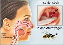 Wann sollten sie zum arzt gehen? Wespenstich Ursachen Symptome Behandlung Medlexi De