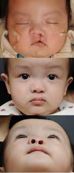 Primary Cleft Rhinoplasty with Custom Suture Needle for Alar Cartilage  Repositioning in Unilateral Cleft Lip Patients: 3D Nasal Analysis