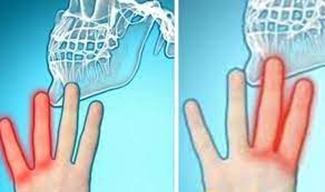 Degete amortite, fumatul, hernia, scleroza multipla sau o suferinta neurologica, hipertensiunea arteriala, diabet zaharat, colesterol crescut, atac de in cazurile cronice, alungati durerea: 5 Boli Periculoase Ce Au Ca Simptome AmorÈ›irea Mainilor Sau Picioarelor Buna Ziua Iasi Bzi Ro