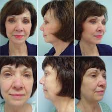 FACELIFT by: Dr. C. Jeff Kesler With over 31 years of experience as a board  certified plastic surgeon Dr. Kesler has perfected his surgical technique.  His goal for you is to leave