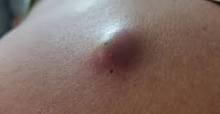 هل الكيس الدهني خطير إليك الإجابة ويب طب