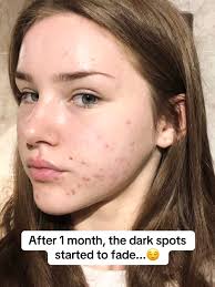 Hailey Baylee Face Treatment