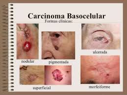 Il carcinoma basocellulare (bcc) è la forma di carcinoma cutaneo più diffusa e tra tutti i tipi di cancro è quello più frequentemente riscontrabile. Carcinoma Basocelular Basalioma Cancer Piel