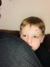 Eli took a 2x8 to the forehead in the form of a swing. Was concerned but he  was very tough and they glued him up right as rain. He is tough like