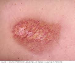 How to heal a burn. Radiation Burn Mayo Clinic