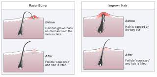 As such, the stretch will slow and you may spot tiny pistils — white hairs that will later become buds — beginning to grow. Ingrown Ingrown Hair Ingrowns Waxing Products Ipl Hair Lily Orchid Beauty Salon