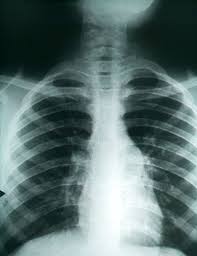 On the 26th i will have a biopsy of the lung. A Fever In The Dust Uci
